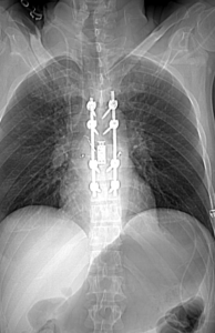 Imaging shows rods and screws in the spine