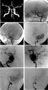 Clinical Images: Persistent Primitive Trigeminal Artery with and without Aneurysm Image