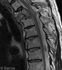 Figure 2. Sagittal T2-weighted MR image shows a destructive lesion of the T2 and T3 vertebrae with involvement of the superior aspect of T4. The spinal canal is compromised, and T2-weighted hyperintensity is apparent in the spinal cord.