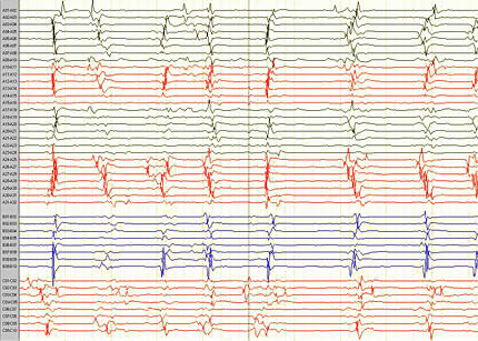 Figure 2. EEG Shows periodic lateralized epileptiform discharges arising from left hemisphere.