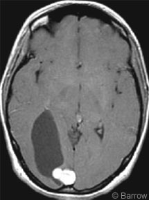 Figure 1. CT of the head shows the cystic lesion.