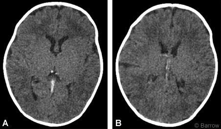 Figure 1. CT scans without contrast show the increased density of the (A) straight sinus and (B) internal cerebral veins, suggestive of an increased hematocrit. Thrombosis could not be excluded.