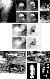 Clinical Images: Lumbar Aneurysmal Bone Cyst Treated with Embolization, Resection, and Anterior-Posterior Fixation