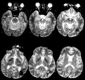  left parieto-occipital cavernous malformation