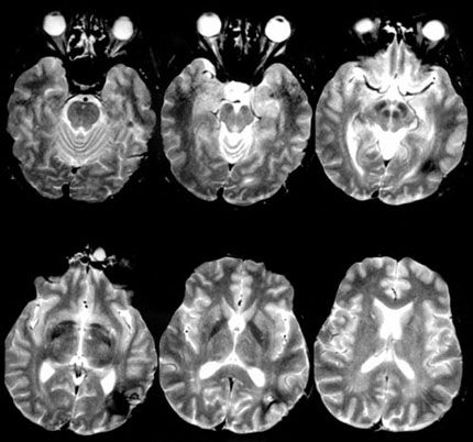 left parieto-occipital cavernous malformation