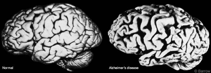 omparison of a normal brain and an atrophied Alzheimer's brain