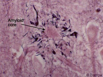 Figure 2. Silver histochemical, beta-amyloid plaque (NP) in a human Alzheimer's brain.