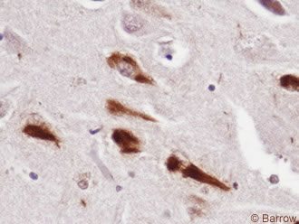 Figure 3. Tau tangles (NFTs) in a hman Alzheimer's brain stained brown with diaminobenzidine using immunohistochemical techniques.