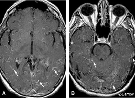 Figure 1. Axial T-1 weighted MR imaging sequences at different levels with gadolinium show prominent cortical vessels (arrow).