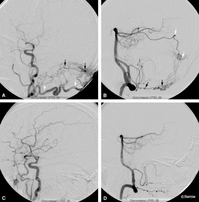 Figure 2. (A) Digital subtraction angiogram of the right common carotid artery shows the DAVF involving the occipital artery (white arrows) and transverse sinus. There is drainage into the cortical veins (black arrows) and transverse sinus. (B) Digital subtraction angiogram of the right vertebral artery shows the DAVF involving a muscular branch (black arrows) off the vertebral artery and right posterior cerebral artery (white arrows). (C) Digital subtraction angiogram of the right vertebral artery and right common carotid artery. (D) Digital subtraction angiogram confirms complete obliteration of the DAVF.