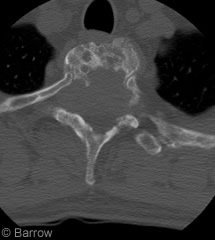 Figure 1. Preoperative CT scan shows a destructive lesion involving all three spinal columns within the T3 vertebrae.