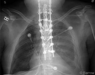 Figure 3. Anteroposterior radiograph shows the patient's anterior and posterior instrumentation.