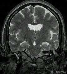 Figure 1. Coronal T2-weighted MR image shows no focal adnormality.