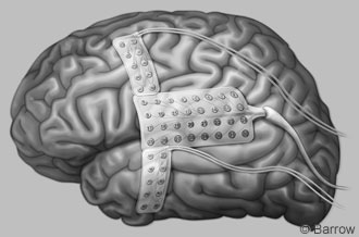 Figure 3. Subdural grid template for recording cortical discharges.