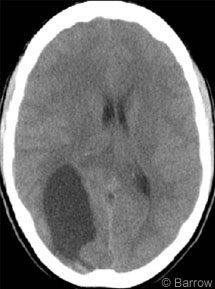 Figure 2. Gadolinium-enhanced T1-weighted MR image of the head shows the cyst and enhancing nodule.