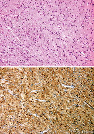 Figure 3. Permanent pathologic sections from the resected tumor nodule show (A) intersecting fascicles of spindle cells within a compact fibrillary stroma—Antoni A (hematoxylin and eosin, original magnification x200) and (B) strong diffuse S-100 immunoreactivity of the tumor cells (S-100, DAB-hematoxylin, original magnification x200). The pathologic findings are diagnostic of schwannoma.