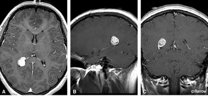 Figure 1. (A) Axial, (B) sagittal, and (C) coronal enhanced T1-weighted MR images show a well-demarcated, 2-cm mass associated with the choroid plexus within the atrium of the right lateral ventricle.