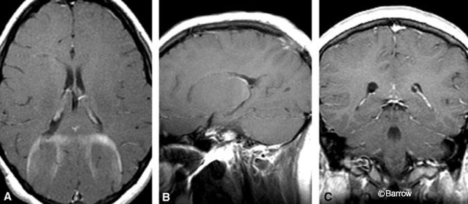 Figure 3. (A) Axial, (B) sagittal, and (C) coronal enhanced T-1 weighted MR images obtained 3 months after resection showed no residual tumor. The postoperative changes seen were expected. Artifact from dental hardware is present.