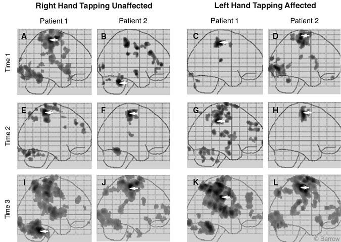 Figure 1. Maximum intensity projection in the sagittal plane of activation during the finger-tapping task at three different times. Right and left finger tapping for both patients is represented in the left and right columns, respectively. Each panel shows voxels exceeding the threshold for p < 0.01.