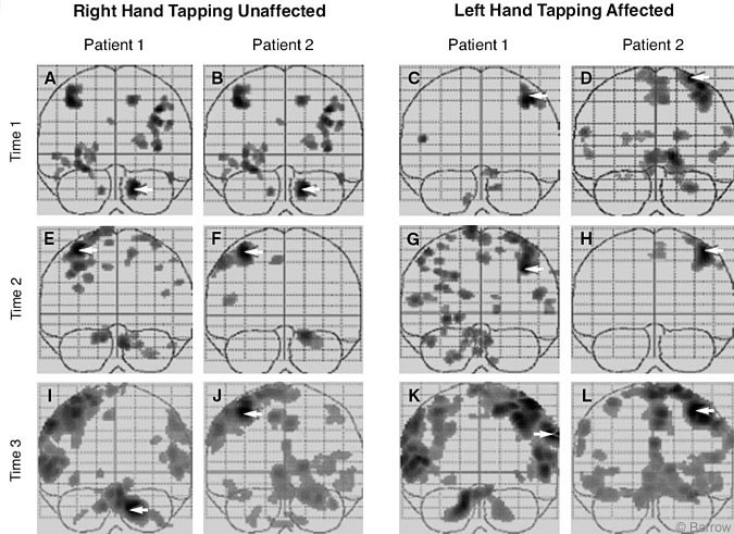 Figure 2. Maximum intensity projection in the coronal plane of activation during the finger-tapping task at three different times. Right and left finger tapping for both patients is represented in the left and right columns, respectively. Each panel shows voxels exceeding the threshold for p < 0.01.