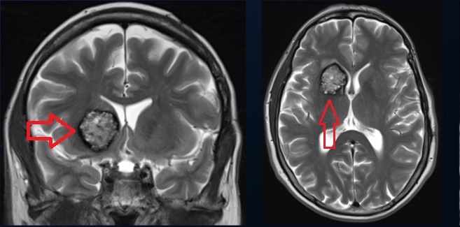 mri showing a cavernous malformation in the brain. the red arrows point to the cavernous malformation