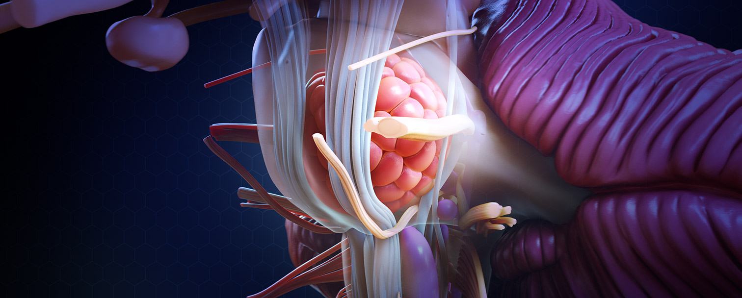 cavernous malformation in the brain