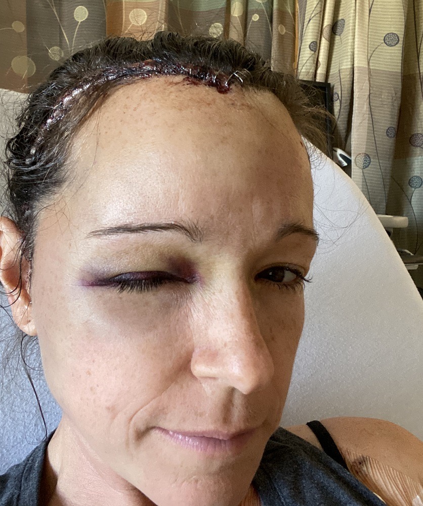 Christi takes a photo of herself in her hospital bed, showing the incision on her scalp and the bruising on her eye