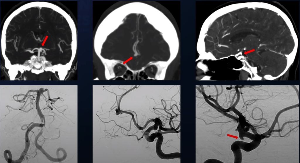 ct angiogram showing a basilar bifurcation brain aneurysm