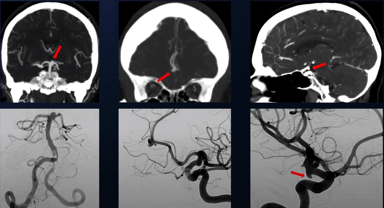 What is Cerebral Aneurysm – Symptoms, Diagnosis and Treatments