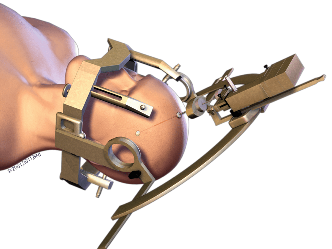 Deep Brain Stimulation Surgery (DBS)