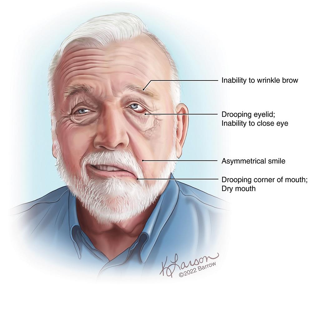 illustration showing the symptoms of facial palsy