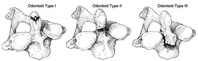 comminuted odontoid fracture type 1 comminuted odontoid fracture type 1