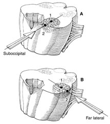 two-point method