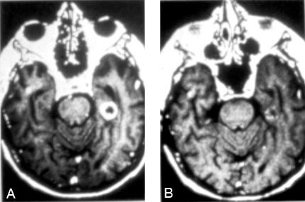 gamma knife metastatic tumors brain microsurgical resection radiosurgery figure tumor treatment courtesy months example before after