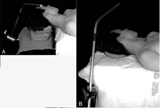Enhancing Rostral Exposure for Carotid Endarterectomy: Technical Report Figure 1