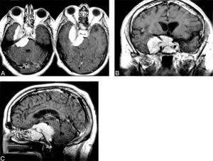 coronal T1-weighted magnetic resonance