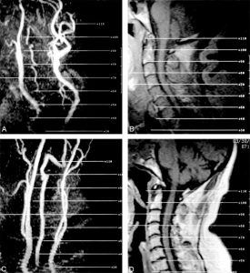 The Practical Use of Magnetic Resonance Angiography for Carotid Endarterectomy Figure 1