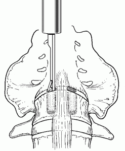 The Laparoscopic Approach for Instrumentation and Fusion of the Lumbar Spine Figure 10