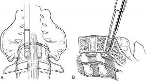 The Laparoscopic Approach for Instrumentation and Fusion of the Lumbar Spine Figure 11