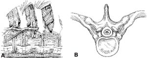 Thoracoscopic Approaches for the Treatment of Anterior Thoracic Spinal Pathology Figure 11