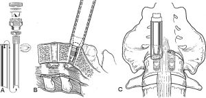 The Laparoscopic Approach for Instrumentation and Fusion of the Lumbar Spine Figure 12