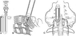 The Laparoscopic Approach for Instrumentation and Fusion of the Lumbar Spine Figure 12