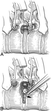 Thoracoscopic Approaches for the Treatment of Anterior Thoracic Spinal Pathology Figure 12