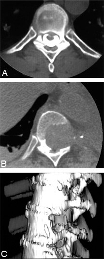 Thoracoscopic Approaches for the Treatment of Anterior Thoracic Spinal Pathology Figure 13