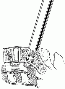 The Laparoscopic Approach for Instrumentation and Fusion of the Lumbar Spine Figure 14