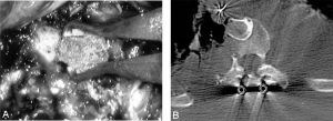 Thoracoscopic Approaches for the Treatment of Anterior Thoracic Spinal Pathology Figure 14