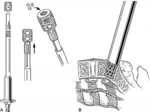 The Laparoscopic Approach for Instrumentation and Fusion of the Lumbar Spine Figure 15