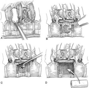 Thoracoscopic Approaches for the Treatment of Anterior Thoracic Spinal Pathology Figure 15