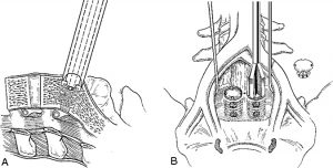 The Laparoscopic Approach for Instrumentation and Fusion of the Lumbar Spine Figure 16