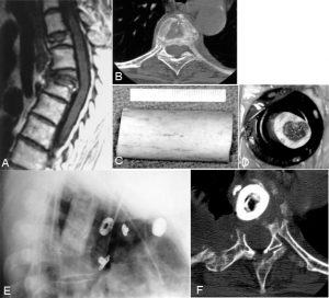 Thoracoscopic Approaches for the Treatment of Anterior Thoracic Spinal Pathology Figure 16